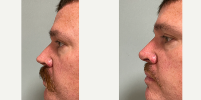 Septoplasty before and after photo