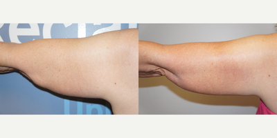 CoolSculpting before and after photo