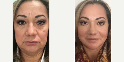 Facelift before and after photo