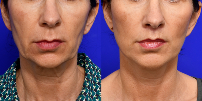 Facelift before and after photo