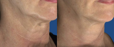 Microneedling before and after photo