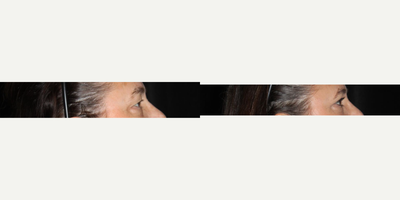Eyelid Surgery before and after photo