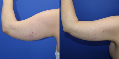 Liposuction before and after photo