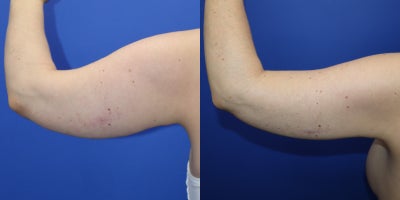 Liposuction before and after photo