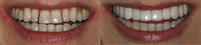Porcelain Veneers before and after photo
