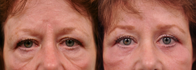 Botox before and after photo