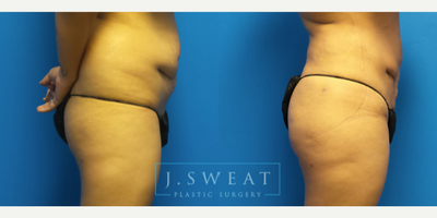Brazilian Butt Lift before and after photo