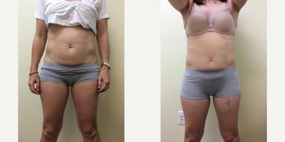 CoolSculpting before and after photo