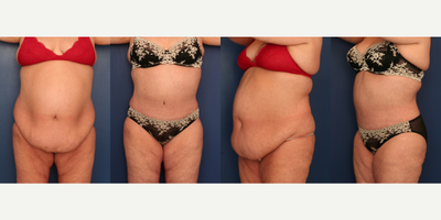 Tummy Tuck before and after photo