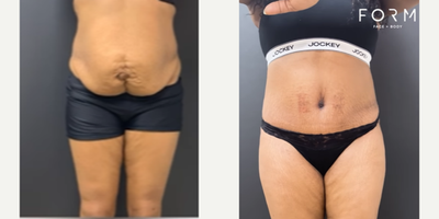Tummy Tuck before and after photo