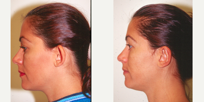 Ear Surgery before and after photo