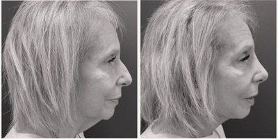 Facelift before and after photo