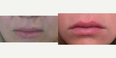 Lip Fillers before and after photo