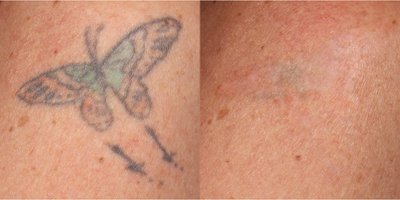 Tattoo Removal before and after photo