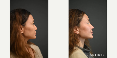 Asian Rhinoplasty before and after photo