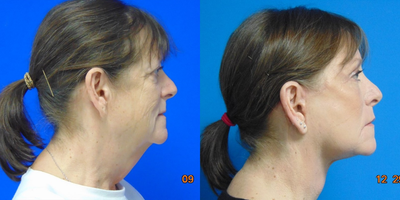 Facelift before and after photo