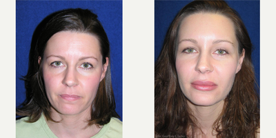 Facial Fat Transfer before and after photo