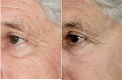 Laser Resurfacing before and after photo