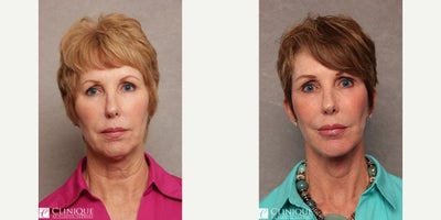 Neck Lift before and after photo
