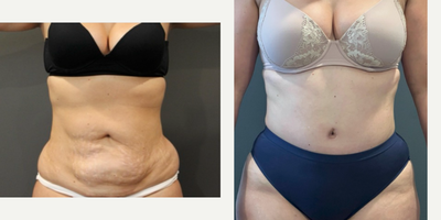 Tummy Tuck before and after photo