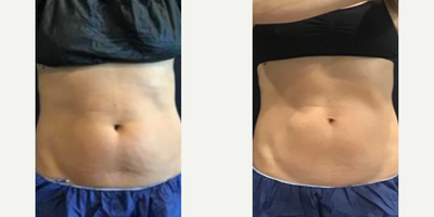 CoolSculpting before and after photo