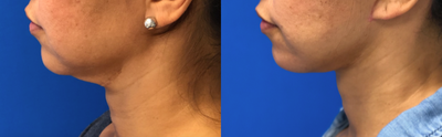 Facelift before and after photo
