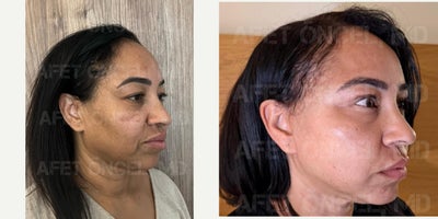 Facelift before and after photo