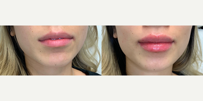 Juvederm before and after photo