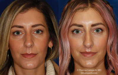 Lip Lift before and after photo