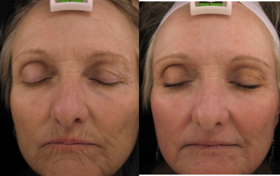 Laser Resurfacing before and after photo