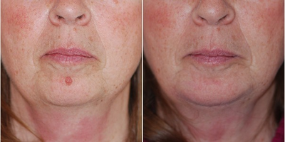 Mole Removal before and after photo