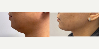 Chin Liposuction before and after photo