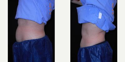 CoolSculpting before and after photo