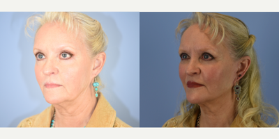 Eyelid Surgery before and after photo