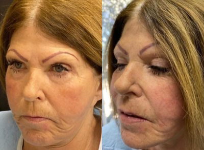 Thread Lift before and after photo