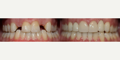 Dental Implants before and after photo