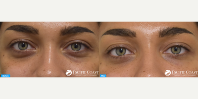Dermal Fillers before and after photo