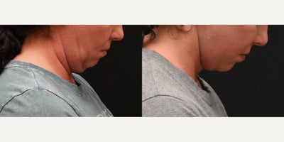 Neck Lift before and after photo