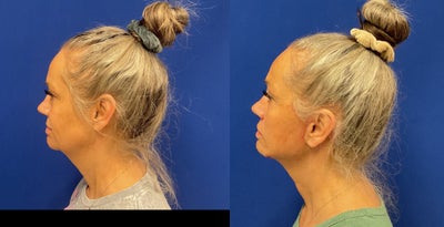 before and after image