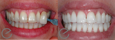 Teeth Whitening before and after photo