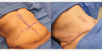 Tummy Tuck before and after photo