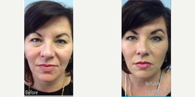 Bellafill before and after photo