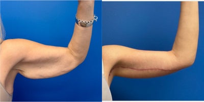 Arm Lift before and after photo