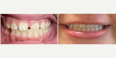 Braces before and after photo