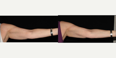 CoolSculpting before and after photo