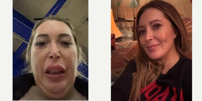 Eyelid Surgery before and after photo