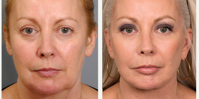 Facelift before and after photo