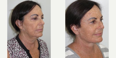 Facelift before and after photo