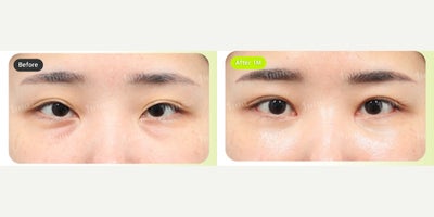 Canthoplasty before and after photo