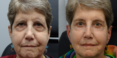 CO2 Laser before and after photo